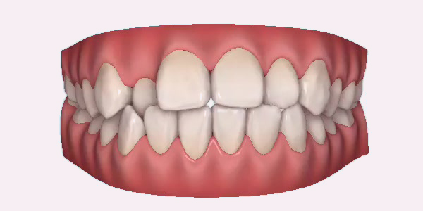 Invisalign Clear Braces - Courthouse Dental & Implants